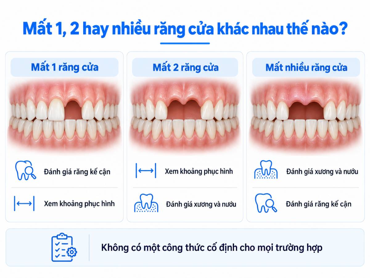 Số lượng răng cửa bị mất là dữ kiện quan trọng, nhưng không tự quyết định phương pháp phục hồi.